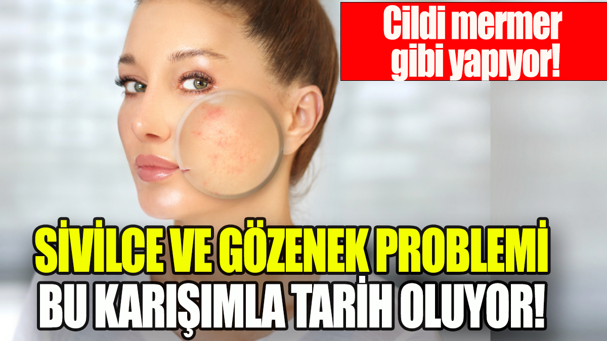 Sivilce ve gözenek problemi bu karışımla tarih oluyor: Cildi mermer gibi yapıyor!