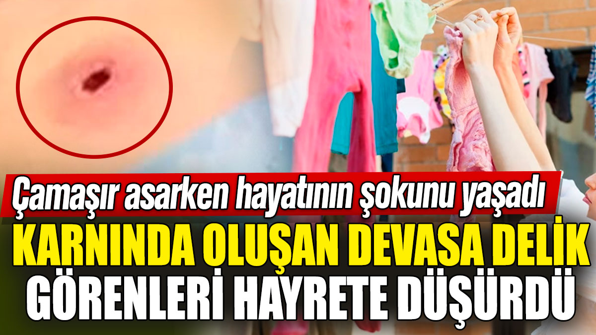 Çamaşır asarken hayatının şokunu yaşadı! Karnında oluşan devasa delik görenleri hayrete düşürdü