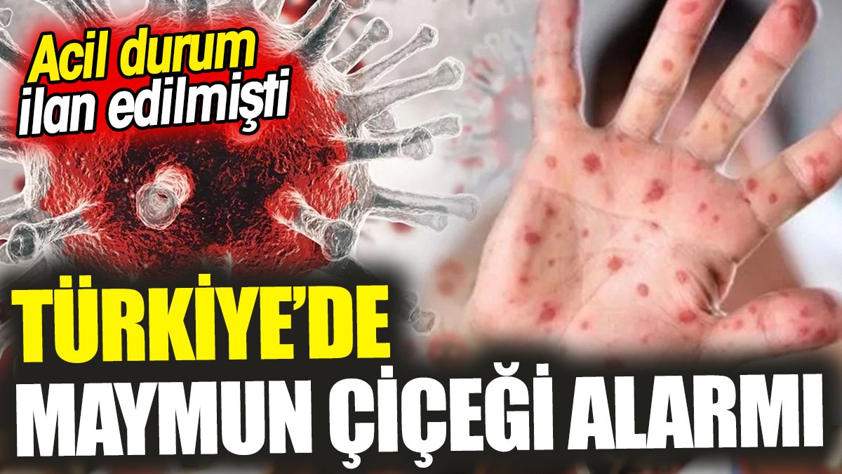 Türkiye’de maymun çiçeği alarmı ‘Acil durum ilan edilmişti’