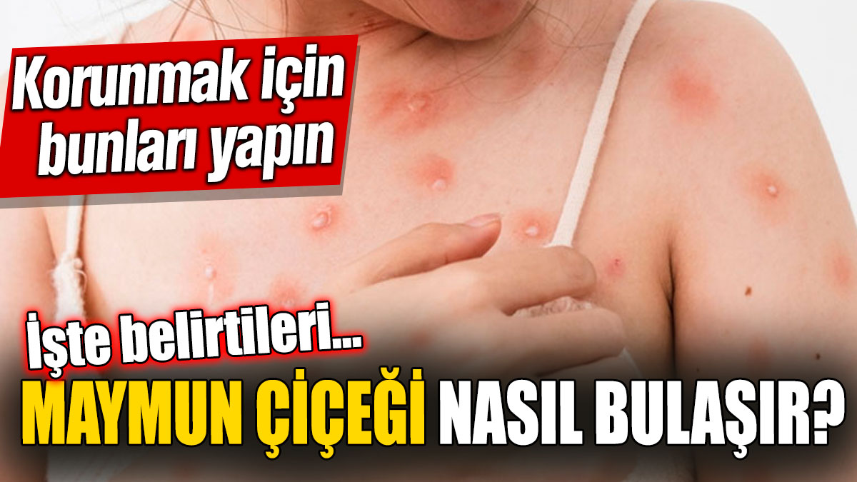 Maymun çiçeği nasıl bulaşır? Korunmak için bunları yapın. İşte belirtileri…