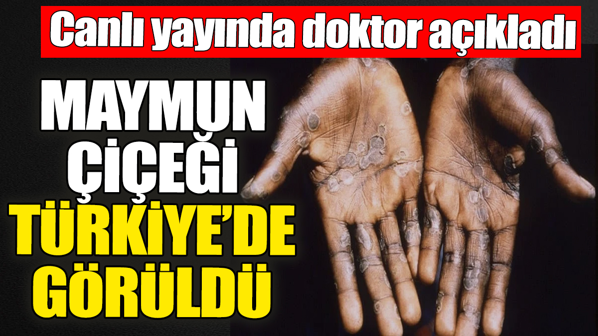 Maymun Çiçeği Türkiye’de görüldü! Uzman doktor canlı yayında açıkladı