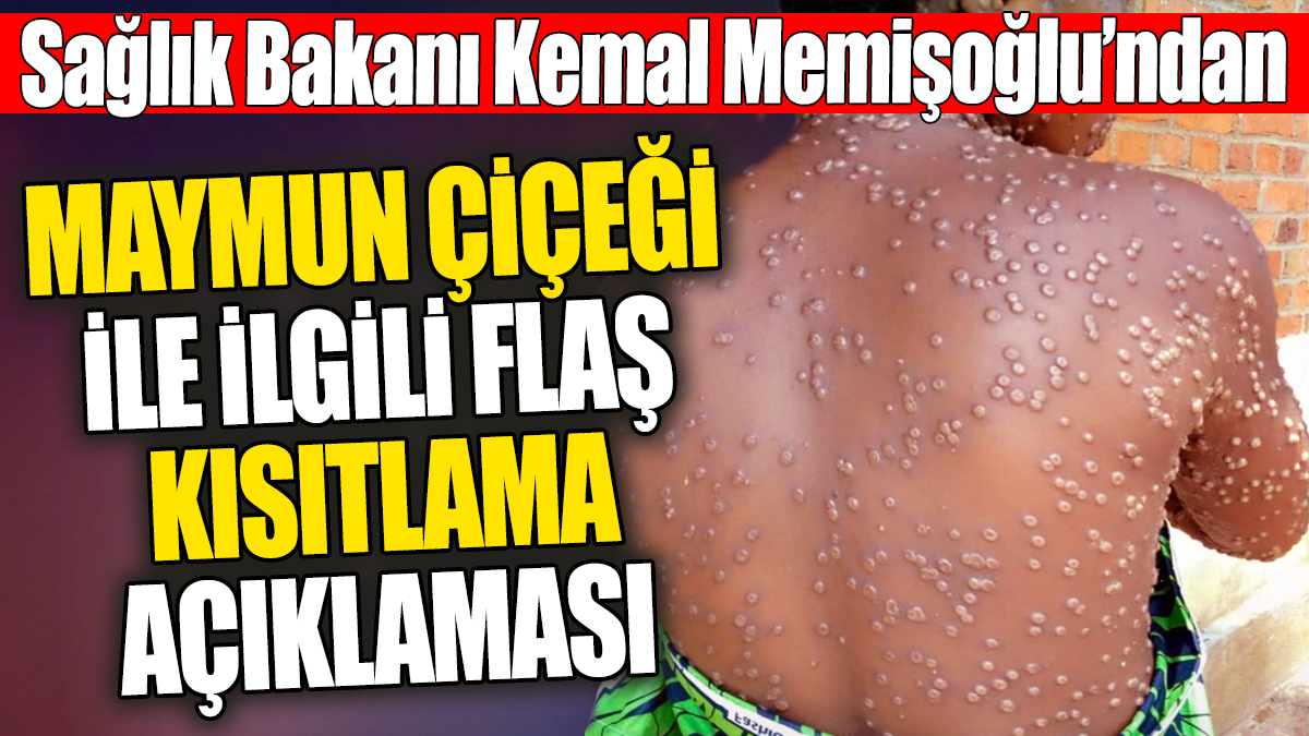 Son Dakika! Memişoğlu'ndan Maymun Çiçeği virüsü ile ilgili flaş kısıtlama açıklaması