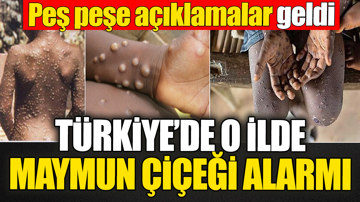 Türkiye’de o ilde Maymun Çiçeği alarmı! Peş peşe açıklamalar geldi