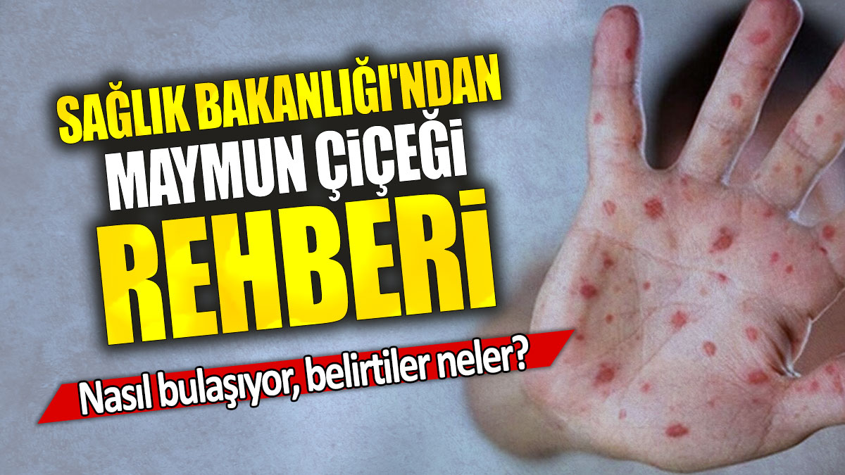 Sağlık Bakanlığı'ndan maymun çiçeği rehberi: Nasıl bulaşıyor, belirtiler neler?