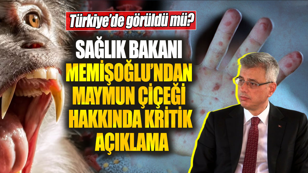 Sağlık Bakanı Memişoğlu’ndan maymun çiçeği hakkında kritik açıklama! Türkiye’de görüldü mü?