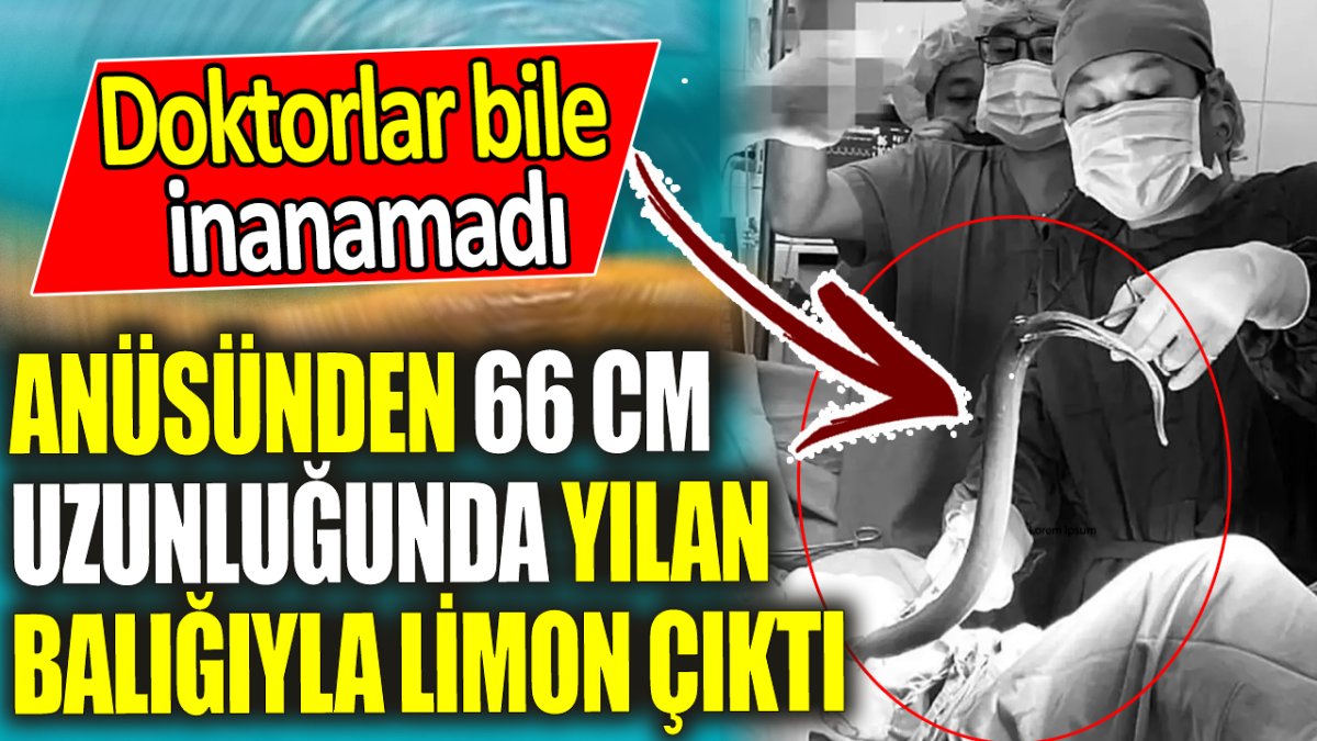 Anüsünden 66 cm uzunluğunda yılan balığıyla limon çıktı ‘Doktorlar bile inanamadı’