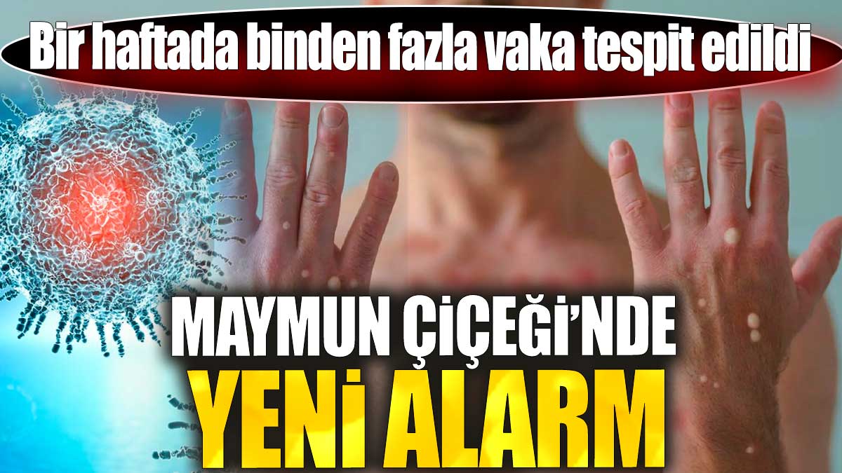 Maymun Çiçeği'nde yeni alarm. Bir haftada binden fazla vaka tespit edildi