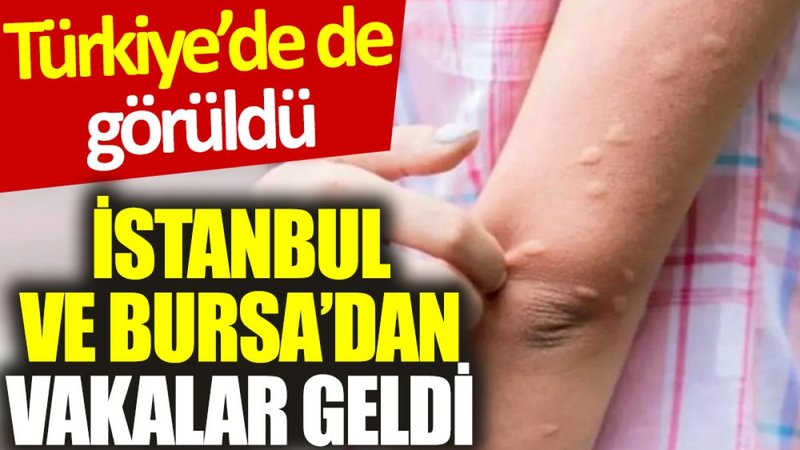Türkiye’de de görüldü: İstanbul ve Bursa'dan vakalar geldi