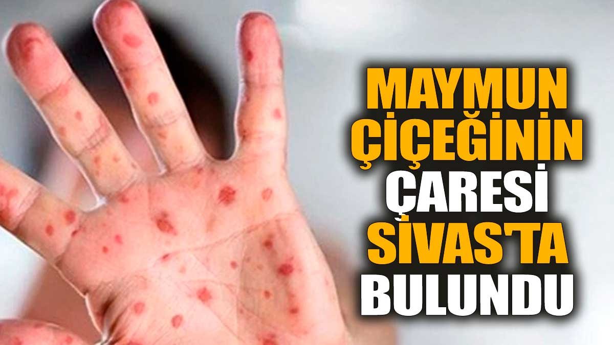 Maymun çiçeğinin çaresi Sivas'ta bulundu