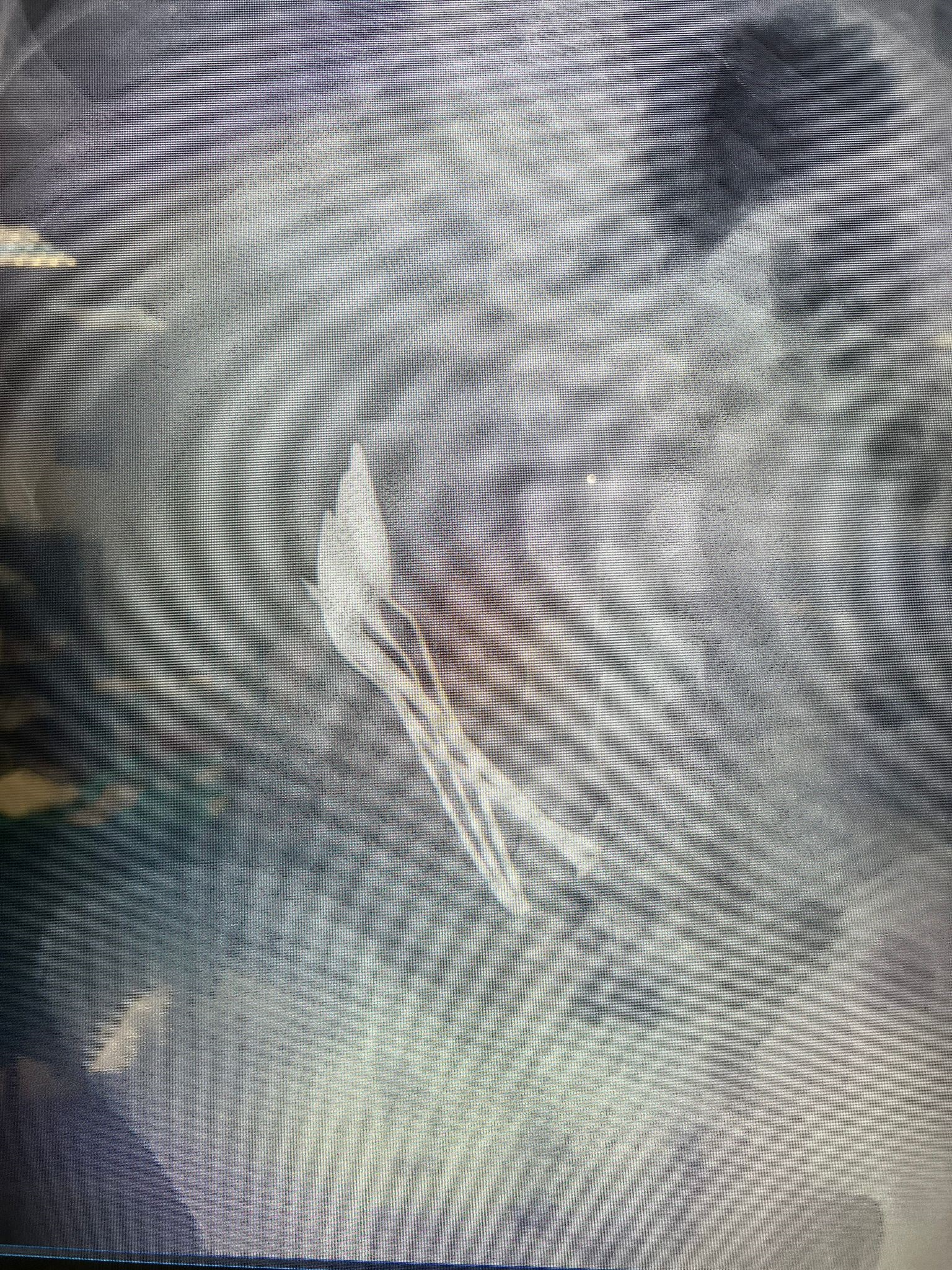 Kayseri'de bir çocuğun midesinden 4 metal tatlı kaşığı ve 1 çivi çıkarıldı