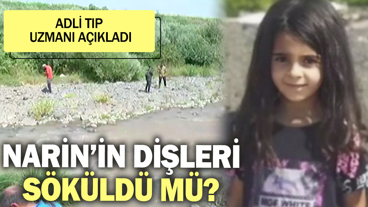 Narin'in dişleri söküldü mü? Adli Tıp Uzmanı açıkladı