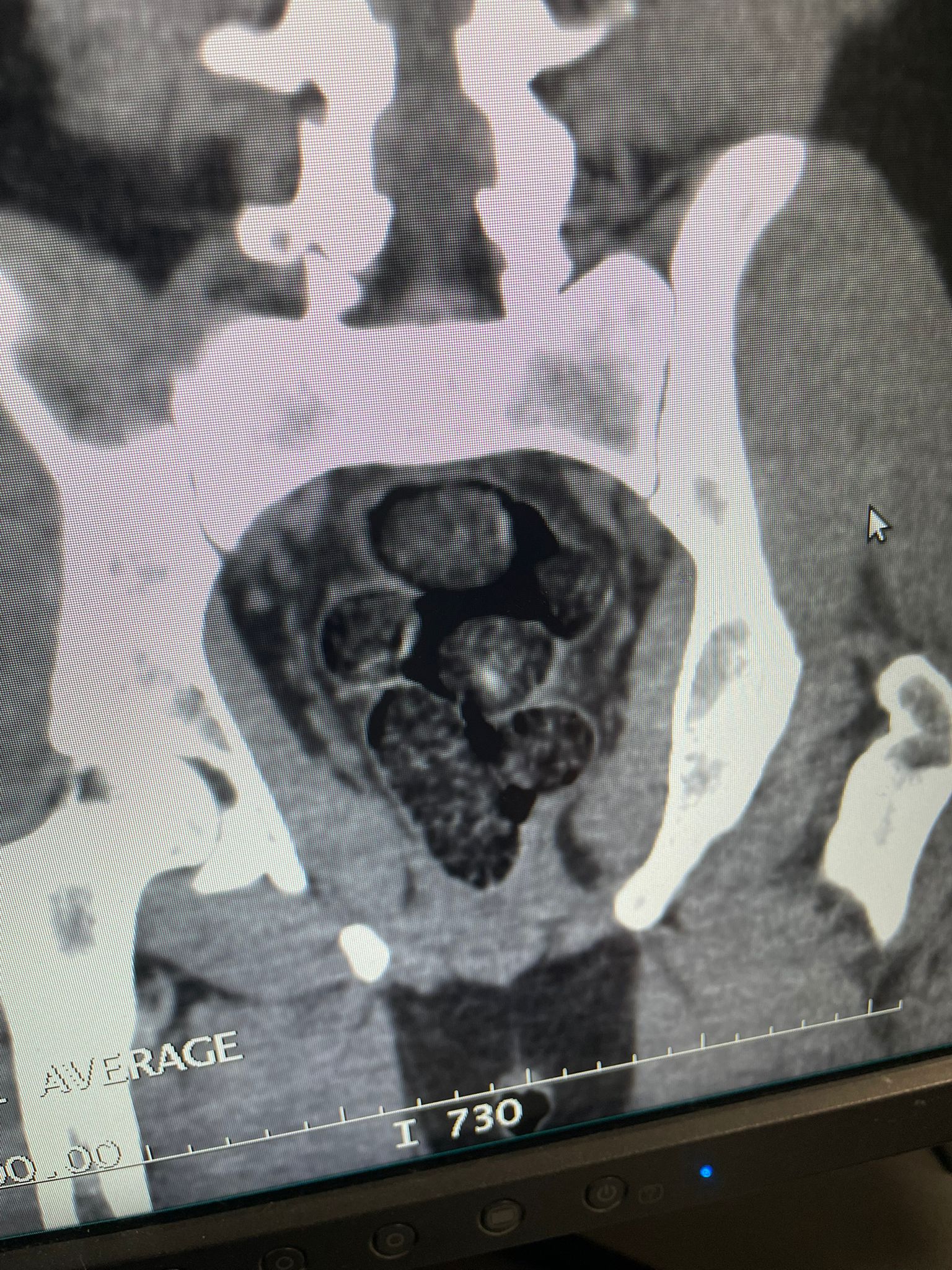 Samsun'da İran uyruklu şahsın midesinden uyuşturucu çıktı