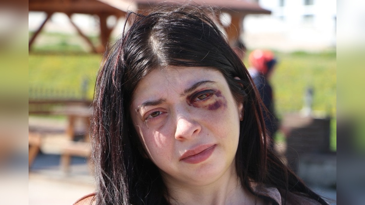 Samsun'da sözlü taciz ve darp: Damla Korkmaz, yüzündeki platinlerle yaşamaya mahkum bırakıldığını söyledi