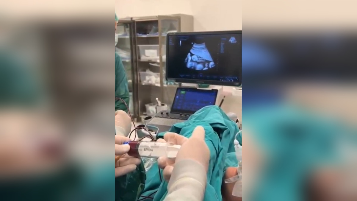 Batman'da 8 aylık bebeğe anne karnında kan nakli yapıldı