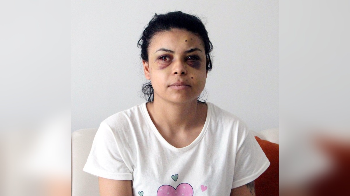 Lüleburgaz'da düğün magandasından 22 yaşındaki Nazar Sepetçi'ye acı darbe: Bir gözünü kaybetme tehlikesiyle karşı karşıya