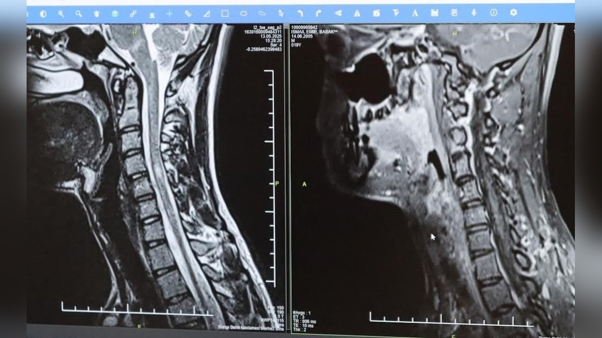 Nöroloji Uzmanı Prof. Dr. Özden Kamışlı: MS hastalığı gençleri etkiliyor