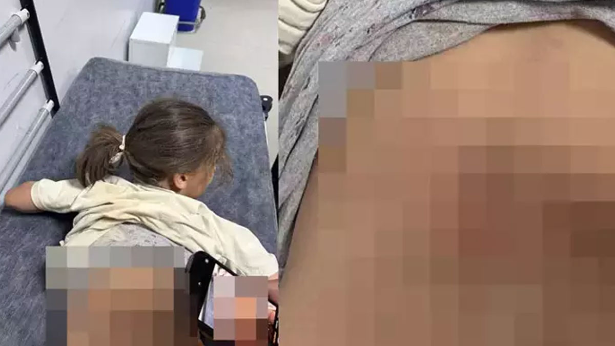 Mardin'de köpeklerin saldırısına uğrayan küçük Zeynep, yaralandı