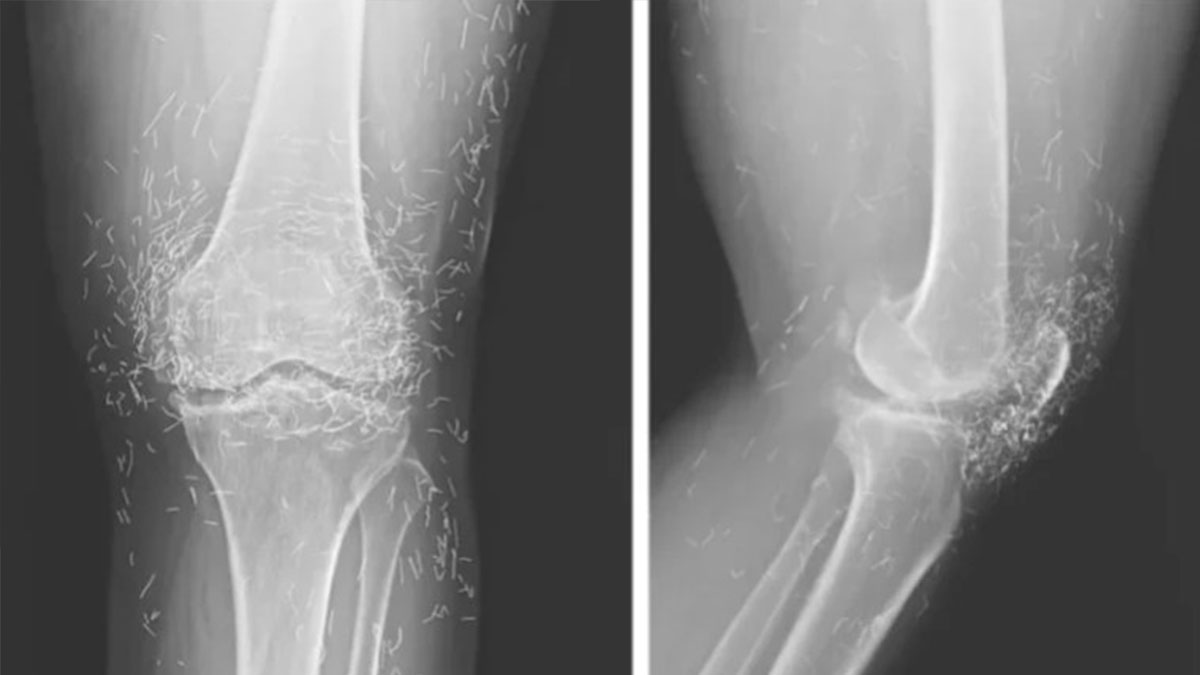 Diz ağrısı şikayetiyle hastaneye gitti! Doktorlar şaşkına döndü