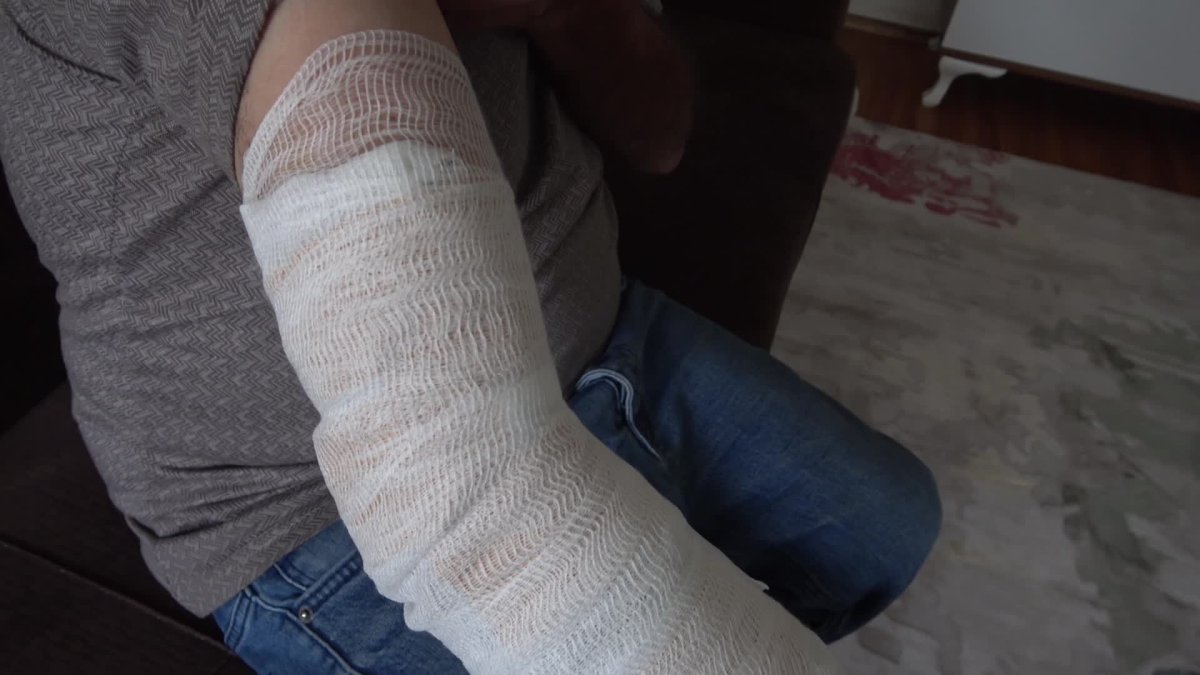 Sokak köpeği tarafından ısırıldı, hayvan sevgisinden vazgeçmedi