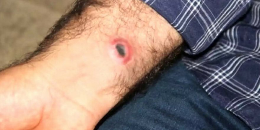 Şarbon hastalığında erken tanı önemli