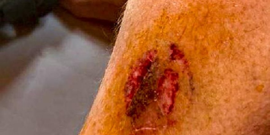 Denize giren kadını caretta ısırdı