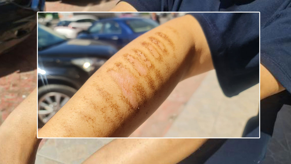 Epilasyona giden kadın hayatının şokunu yaşadı