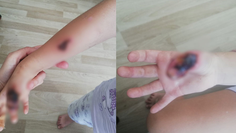 Hastanede skandal olay! Küçük kızın vücudu MR’da yandı