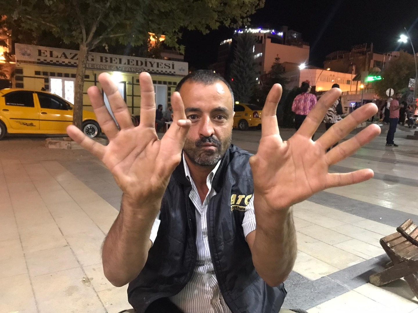 11 parmaklı adam ilçedeki herkesi hayrete düşürüyor