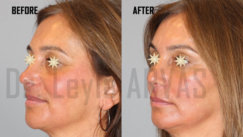 Aydınlık Göz Altları İçin Göz Altı Dolgusu