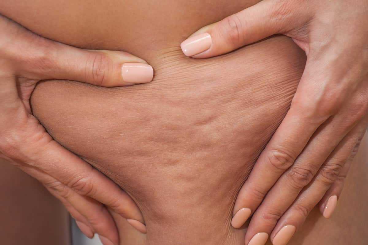 Korkulu rüya: Selülit