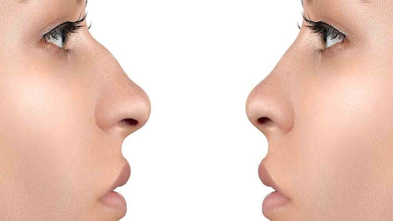 Burun estetiği (rinoplasti) nedir?