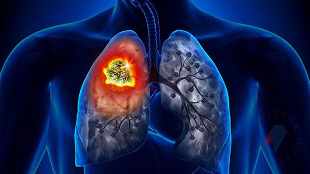 Akciğer kanseri belirtisi nedir? Nasıl fark edilir?