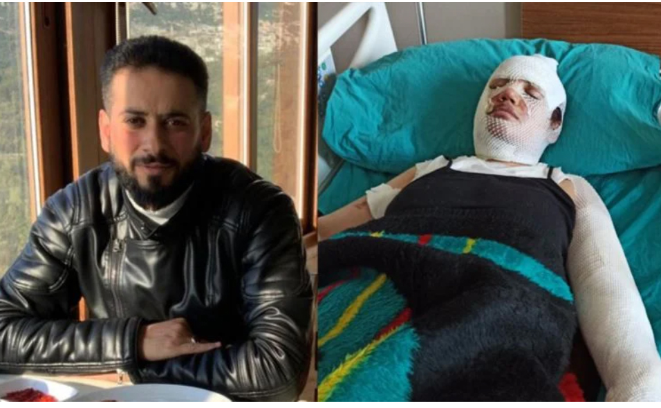 Erkek şiddeti deprem dinlemiyor! Eski eşini kaynar suyla haşladı