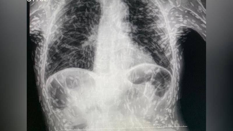 Öksürük şikayetiyle hastaneye midesinden bakın ne çıktı?