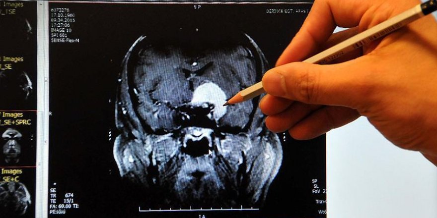 Beynin şekli kişilik farklarını belirliyor