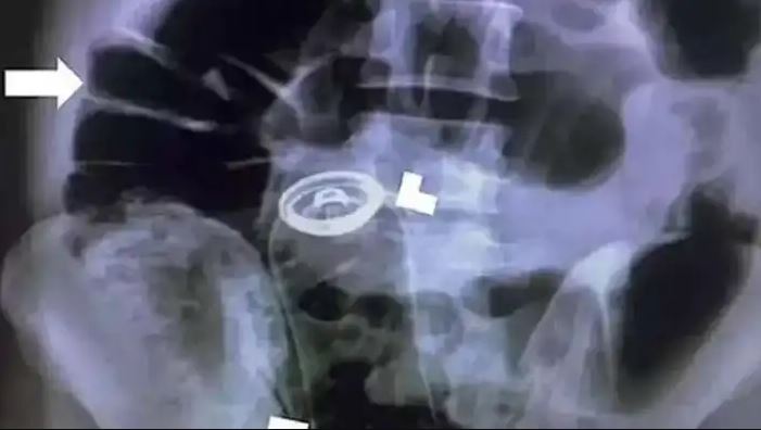 Karın ağrısıyla gitti, iç organlarından deodorant kutusu çıktı