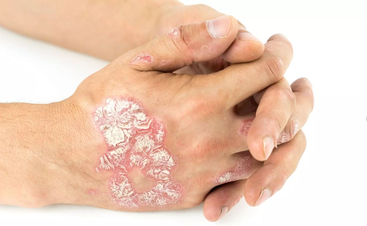 'Sedef' artık tedavisi olan bir hastalık