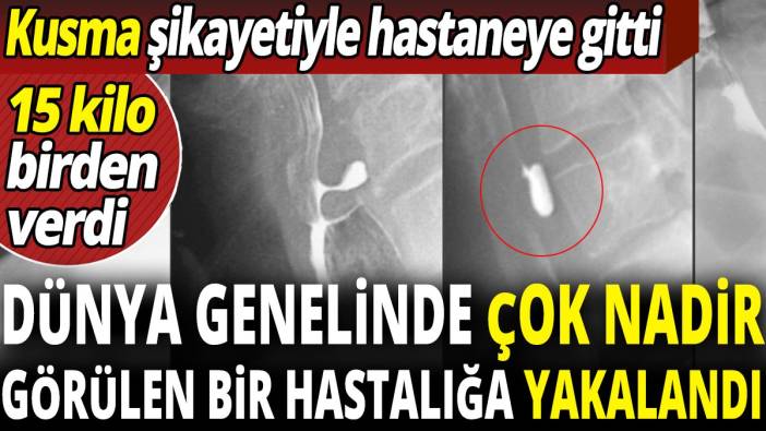 Dünya genelinde çok nadir görülen bir hastalığa yakalandı kusma şikayetiyle gitti '15 kilo birden verdi'