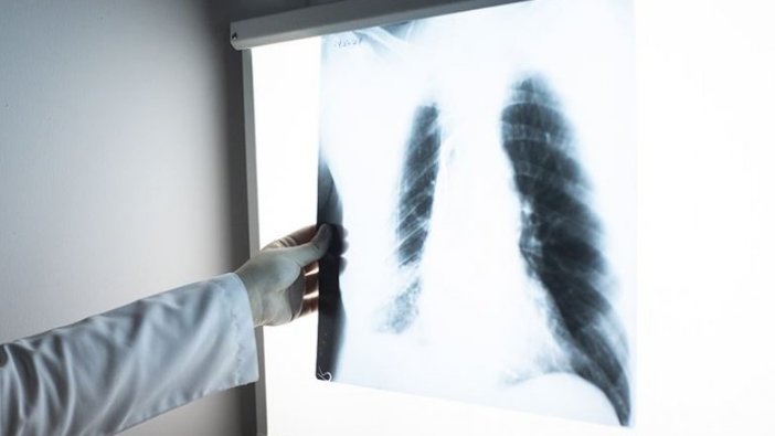Göğüs röntgeninden hastalık teşhisi yapay zekayla hızlanacak