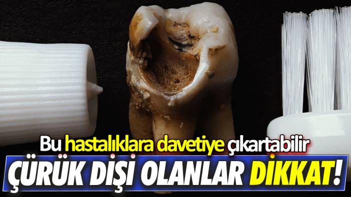 Çürük dişi olanlar dikkat! Bu hastalıklara davetiye çıkartabilir