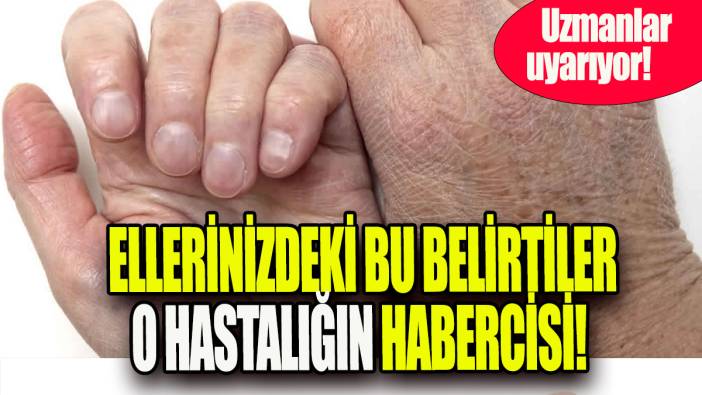 Ellerinizdeki bu belirtiler o hastalığın habercisi: Uzmanlar uyarıyor