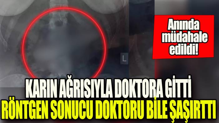 Karın ağrısıyla doktora gitti,röntgen sonucu doktoru bile şaşırttı: Anında müdahale edildi