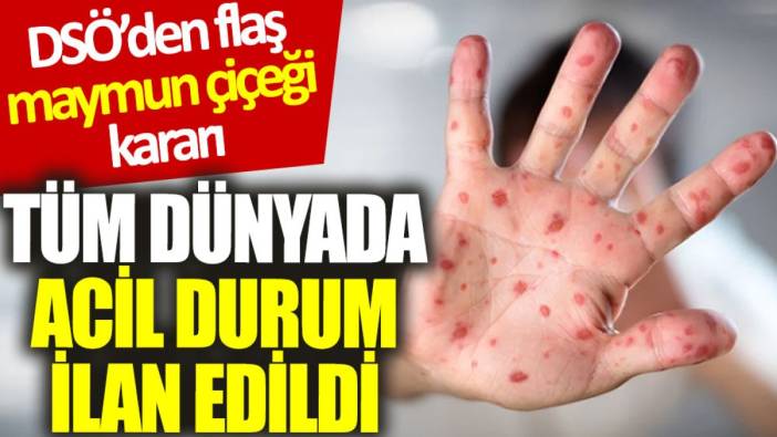 DSÖ’den ‘maymun çiçeği’ kararı: Tüm dünyada acil durum ilan edildi