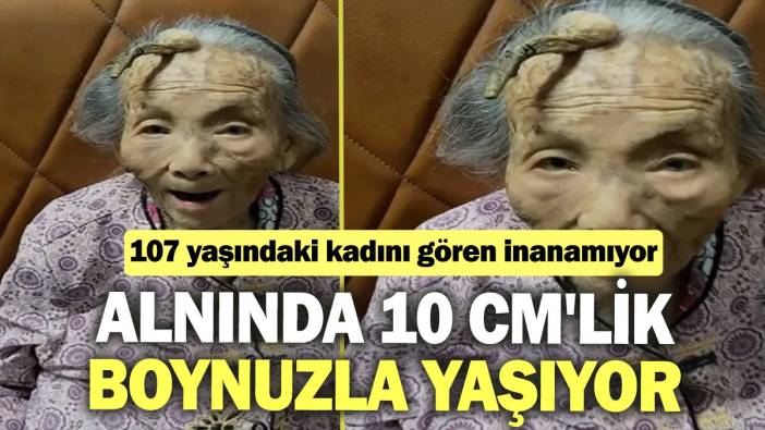 107 yaşındaki kadını gören inanamıyor: Alnında 10 cm'lik boynuzla yaşıyor