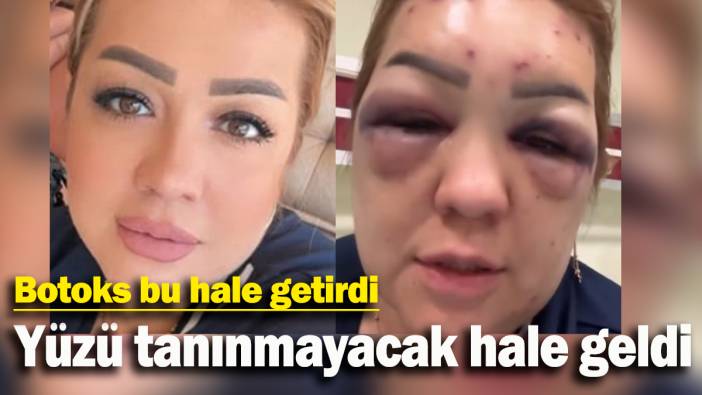 Botoks bu hale getirdi: Yüzü şişti tanınmayacak hale geldi