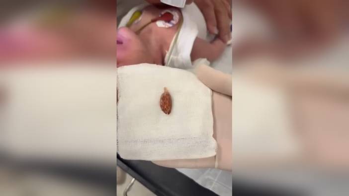 Batman'da 16 Günlük Bebek, Ağabeyinin Verdiği Badem Şekeri Nedeniyle Ameliyata Alındı