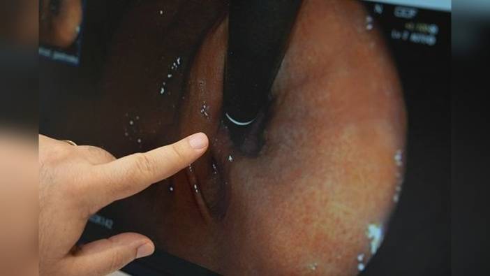 Prof. Dr. Murat Sarıkaya: İnflamatuvar bağırsak hastalıkları doğru tedaviyle kontrol altına alınabilir