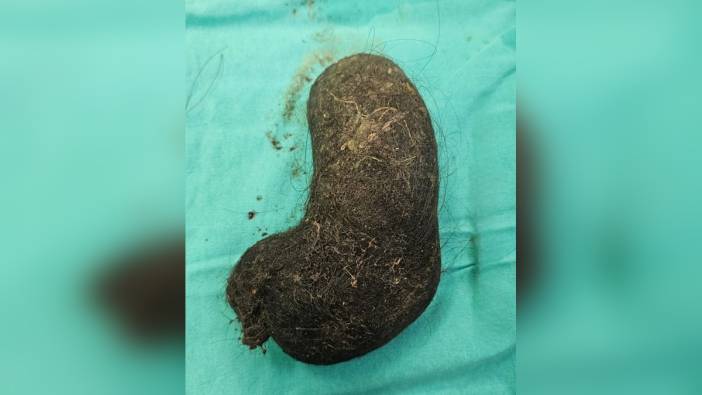 Eskişehir'de 9 yaşındaki B.G.'nin midesinden saç yumağı çıkarıldı