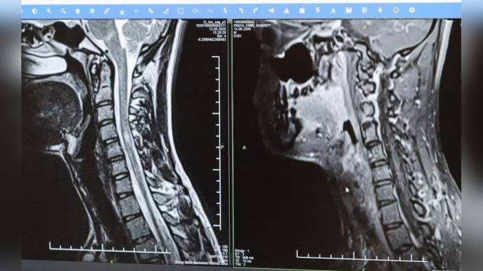 Nöroloji Uzmanı Prof. Dr. Özden Kamışlı: MS hastalığı gençleri etkiliyor
