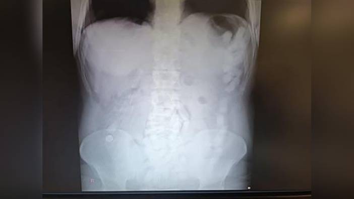 Kayseri'de midesinde 729 gram uyuşturucuyla yakalanan şahsa 12 yıl 6 ay hapis cezası